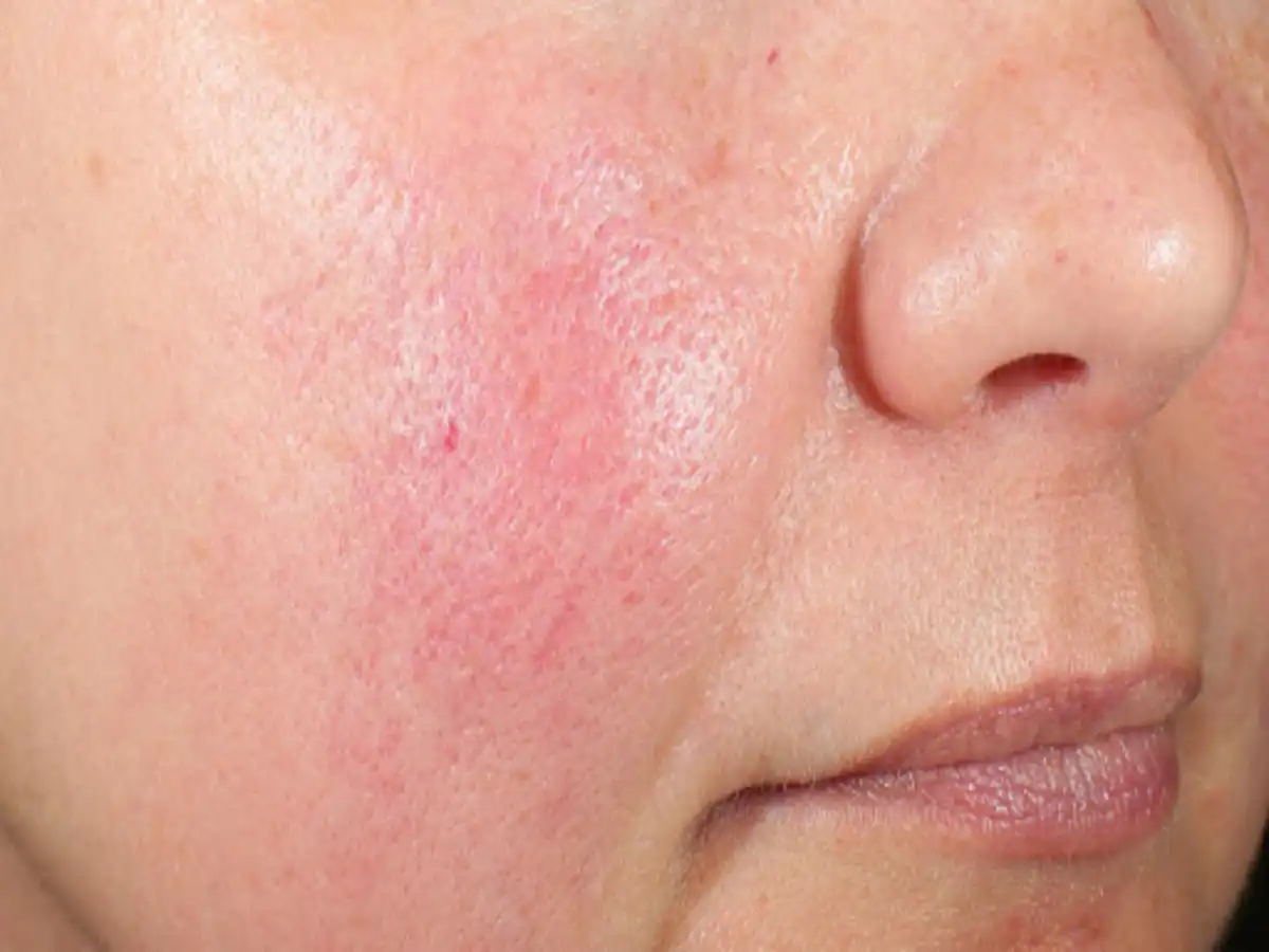 How to Repair a Damaged Skin Barrier Professionally