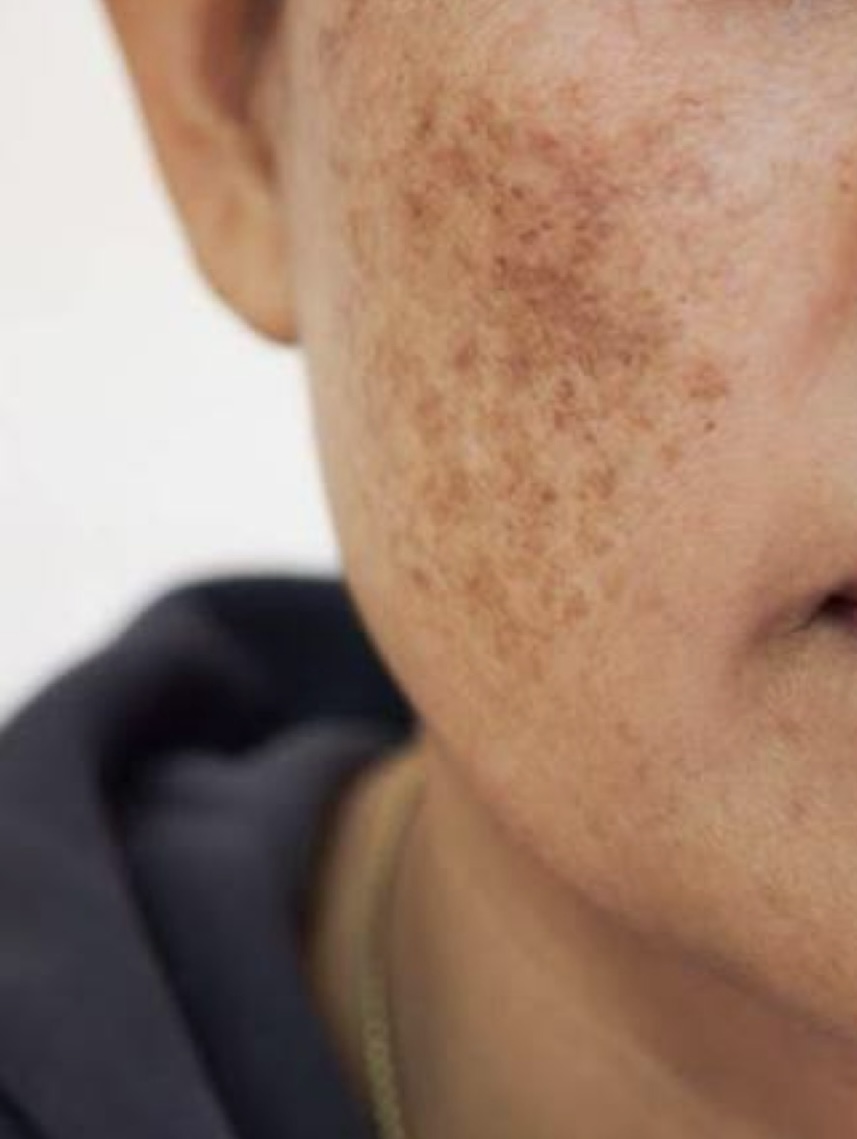 Hormonal Skin Pigmentation / Melasma Flare