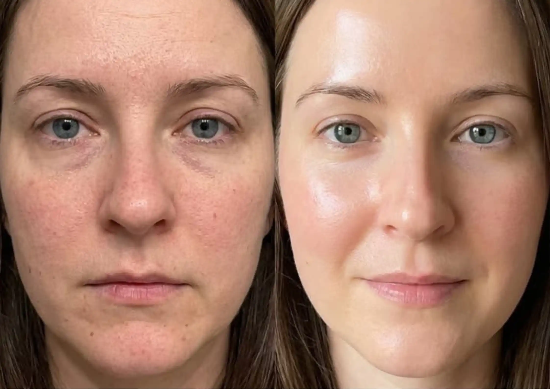 Dehydrated vs Dry Skin: The Difference That Changes Your Treatment Plan
