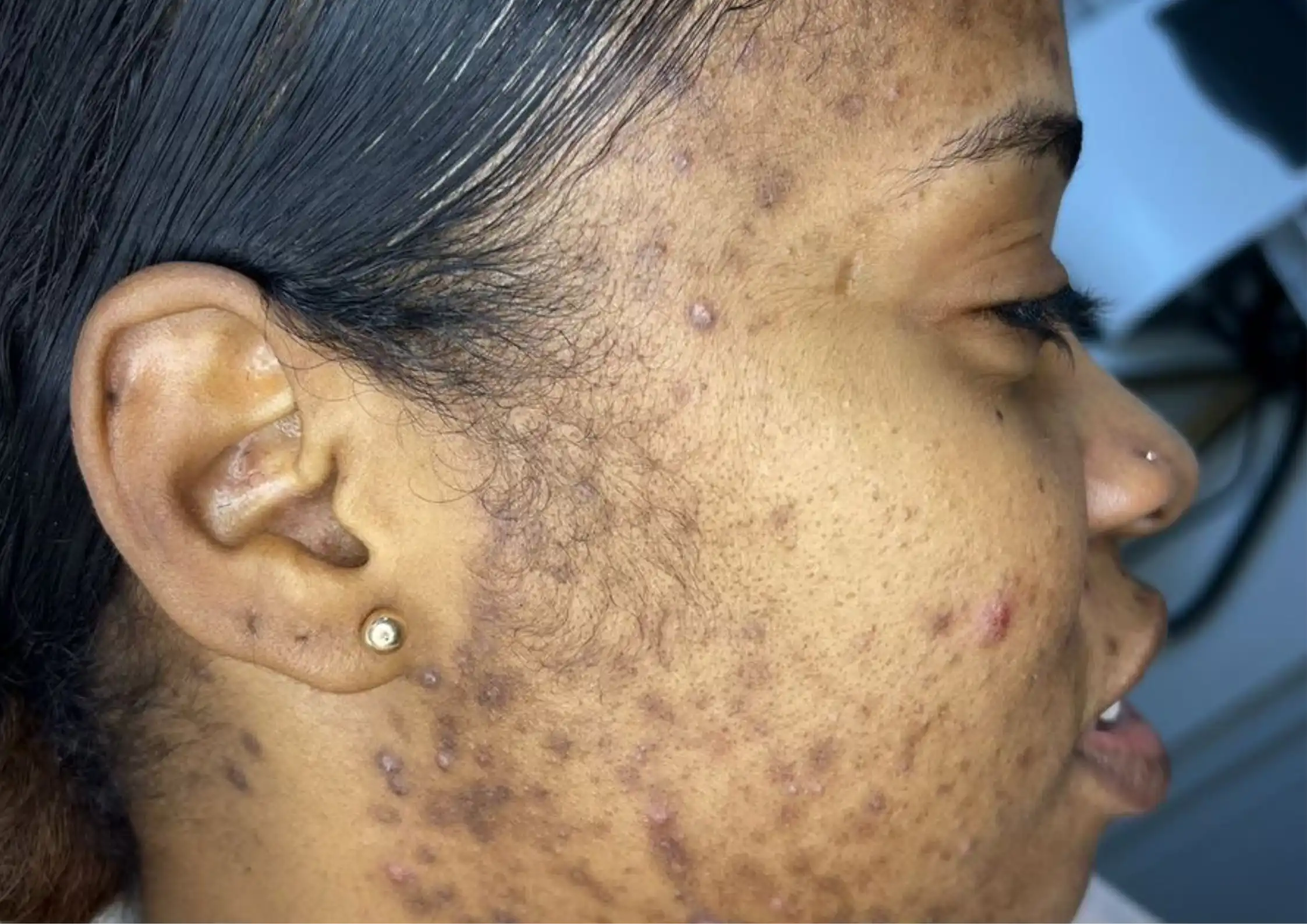 Hard Water, Inflammation & Skin Sensitivity: The Hidden Trigger in Hertfordshire