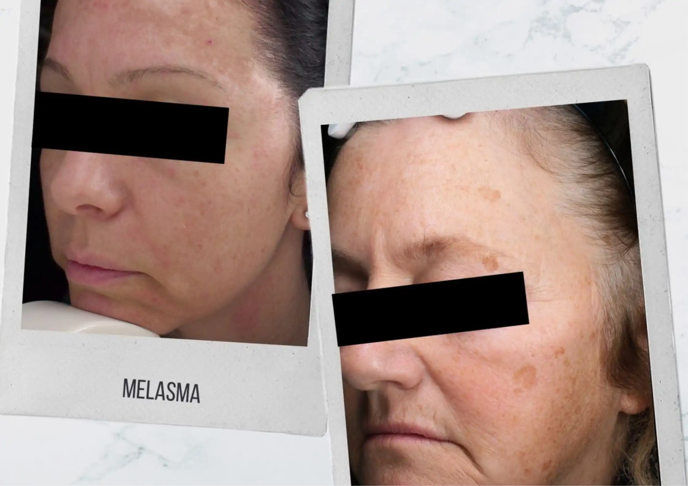 Inflammation-Driven Pigmentation: Why Sensitive Skin Develops Dark Spots