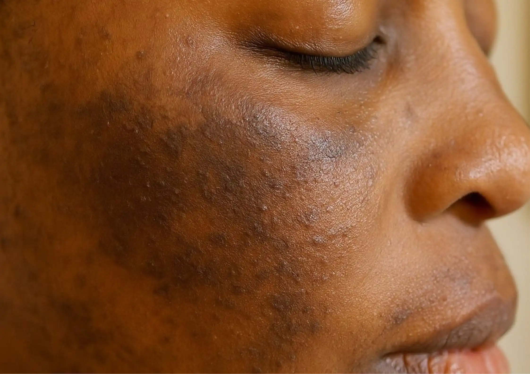 Inflammation-Driven Pigmentation: Why Red Skin Often Develops Dark Spots