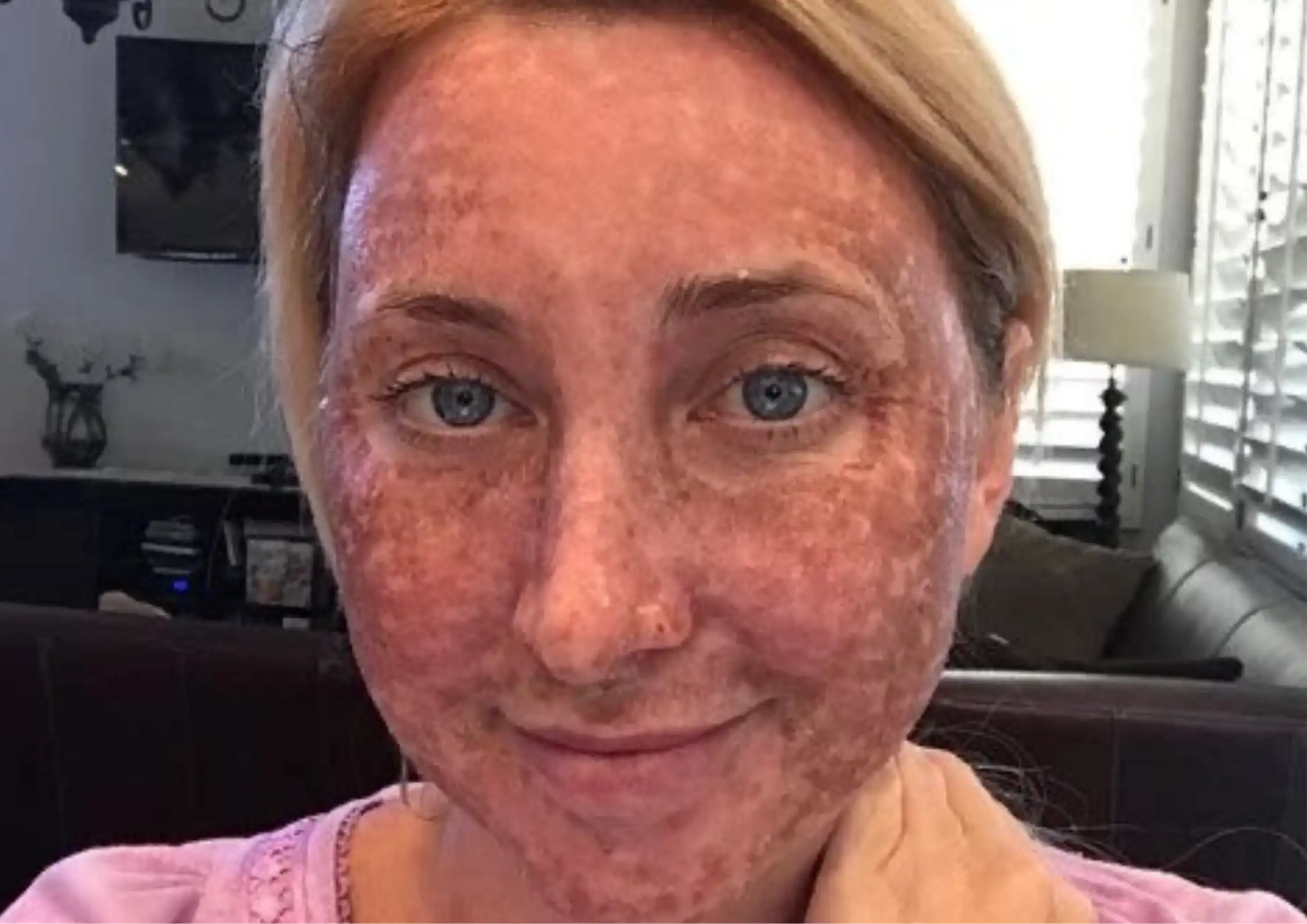 Menopause Pigmentation Patterns: Why Dark Spots Can Suddenly Worsen