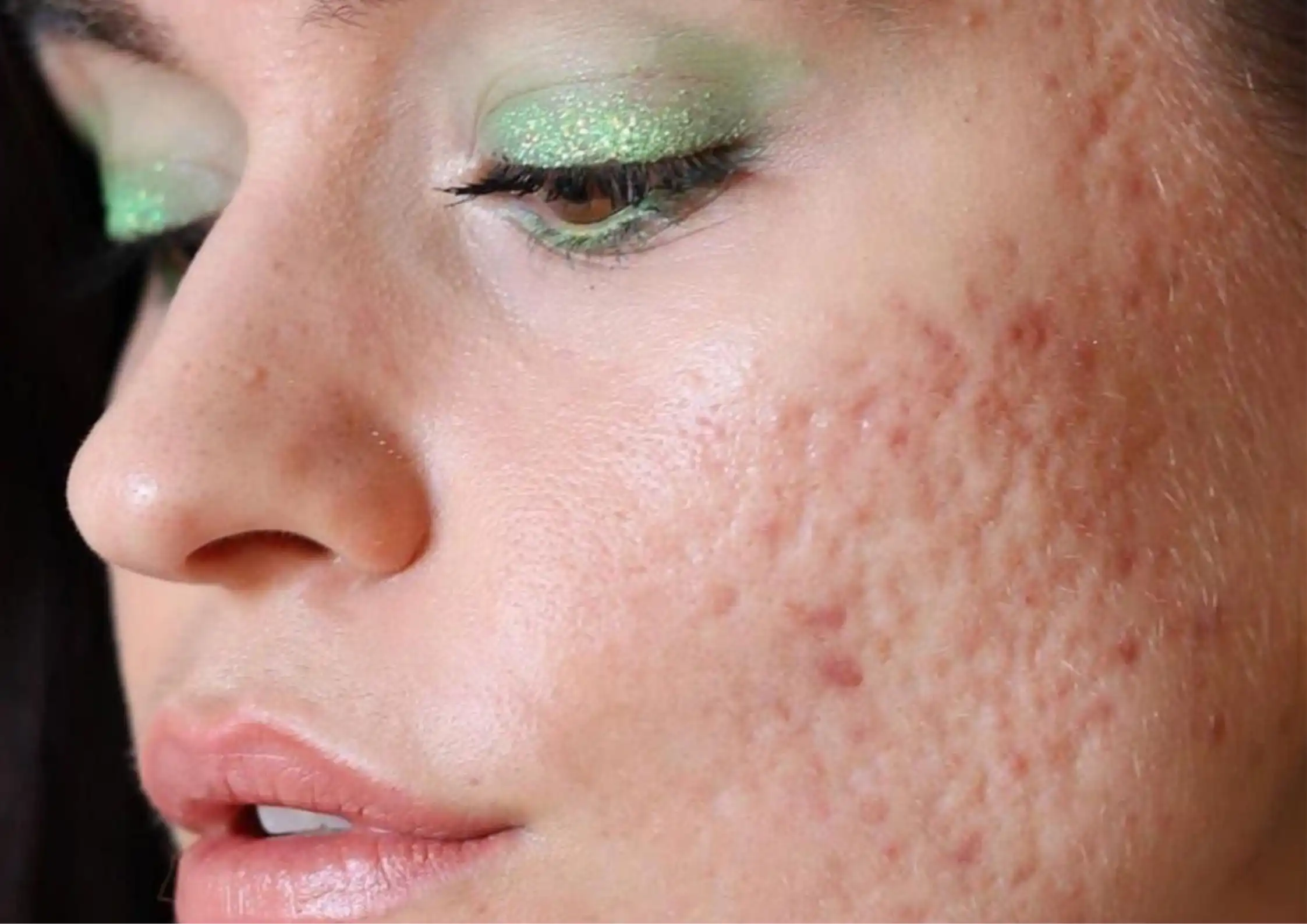 Over-Exfoliated Skin: Signs, Symptoms and How to Reverse Skin Barrier Damage
