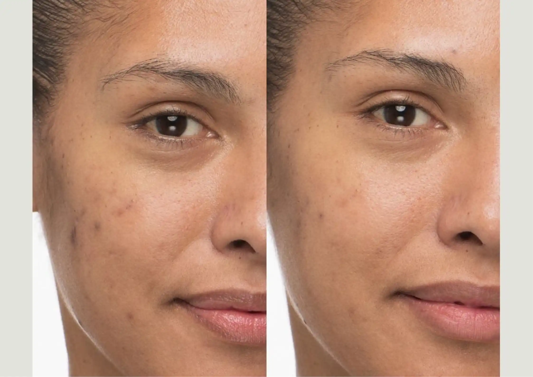 Pigmentation Behaviour: Why Dark Spots Return After Treatment
