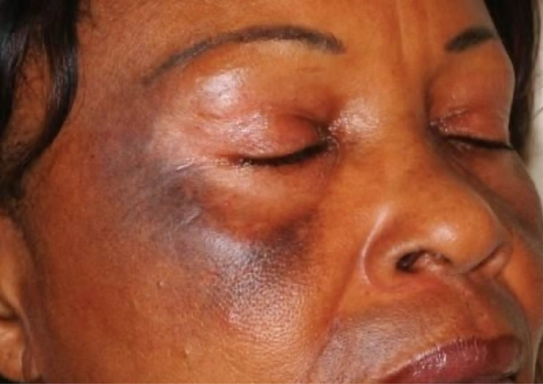 Redness vs Sensitivity: How to Tell If Your Skin Is Inflamed or Barrier-Damaged