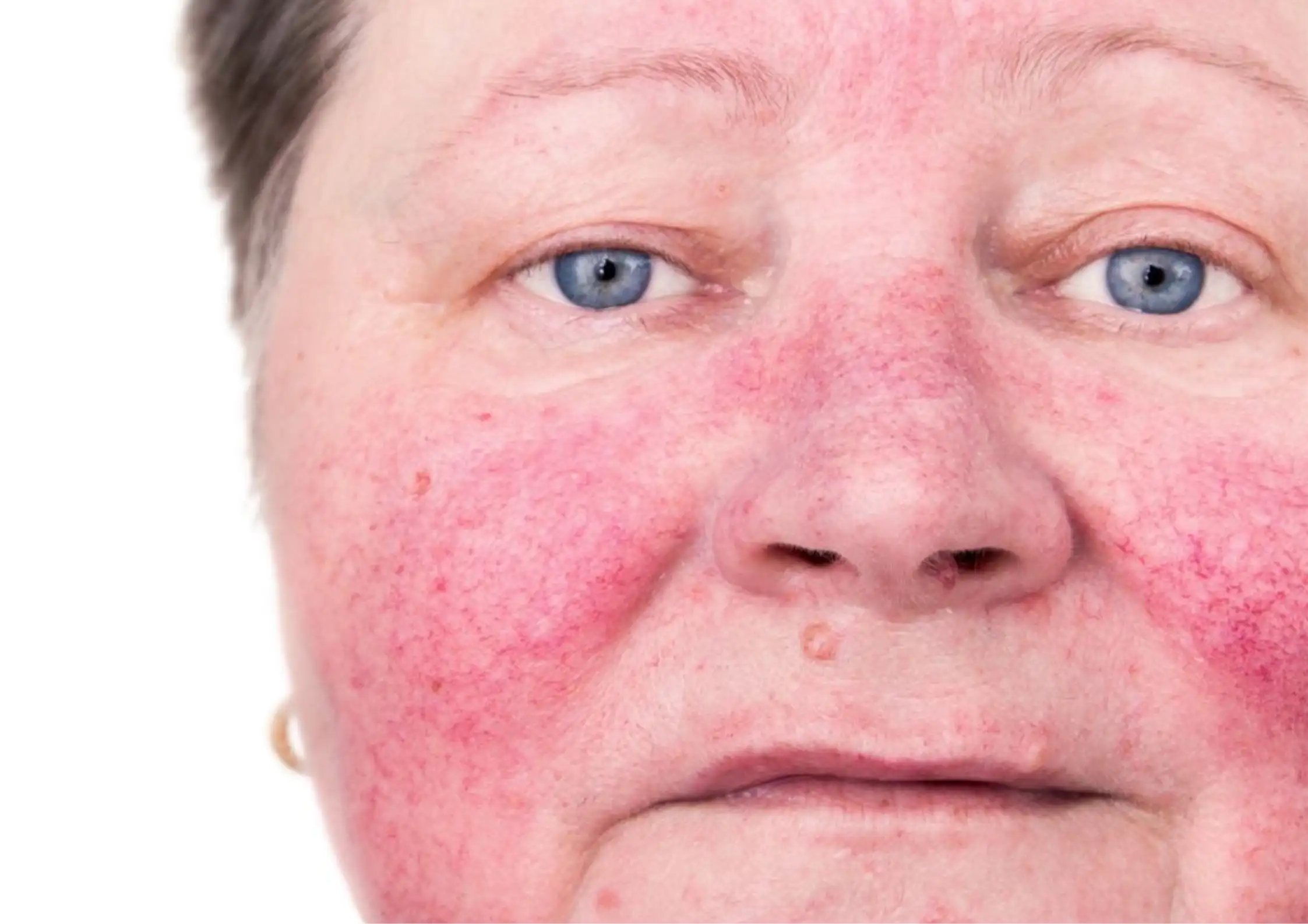 Rosacea Triggers: Heat, Stress, Hormones and Why Flushing Becomes Chronic