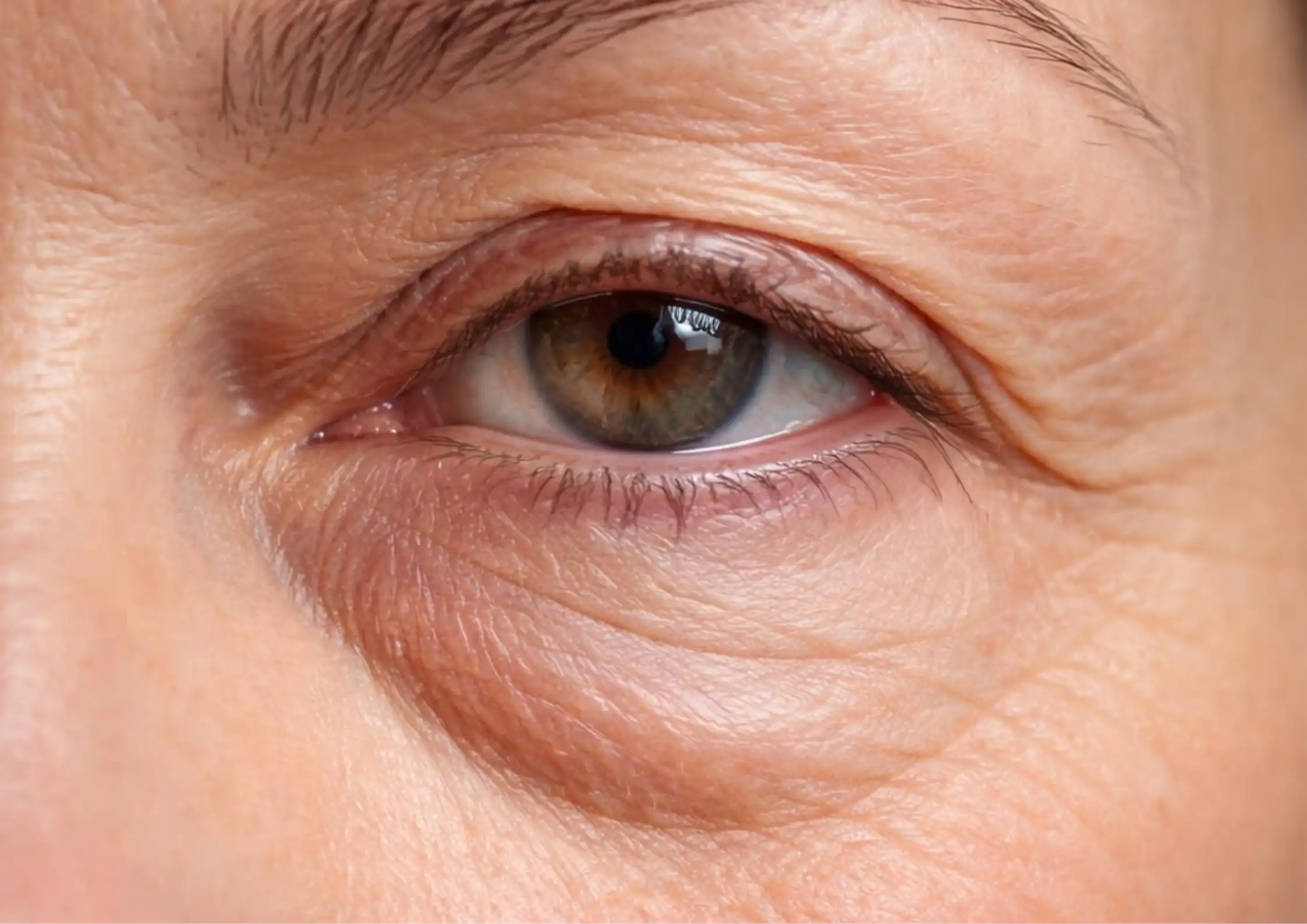 Tear Trough Shadowing: Why Under-Eye Hollows Appear Over Time