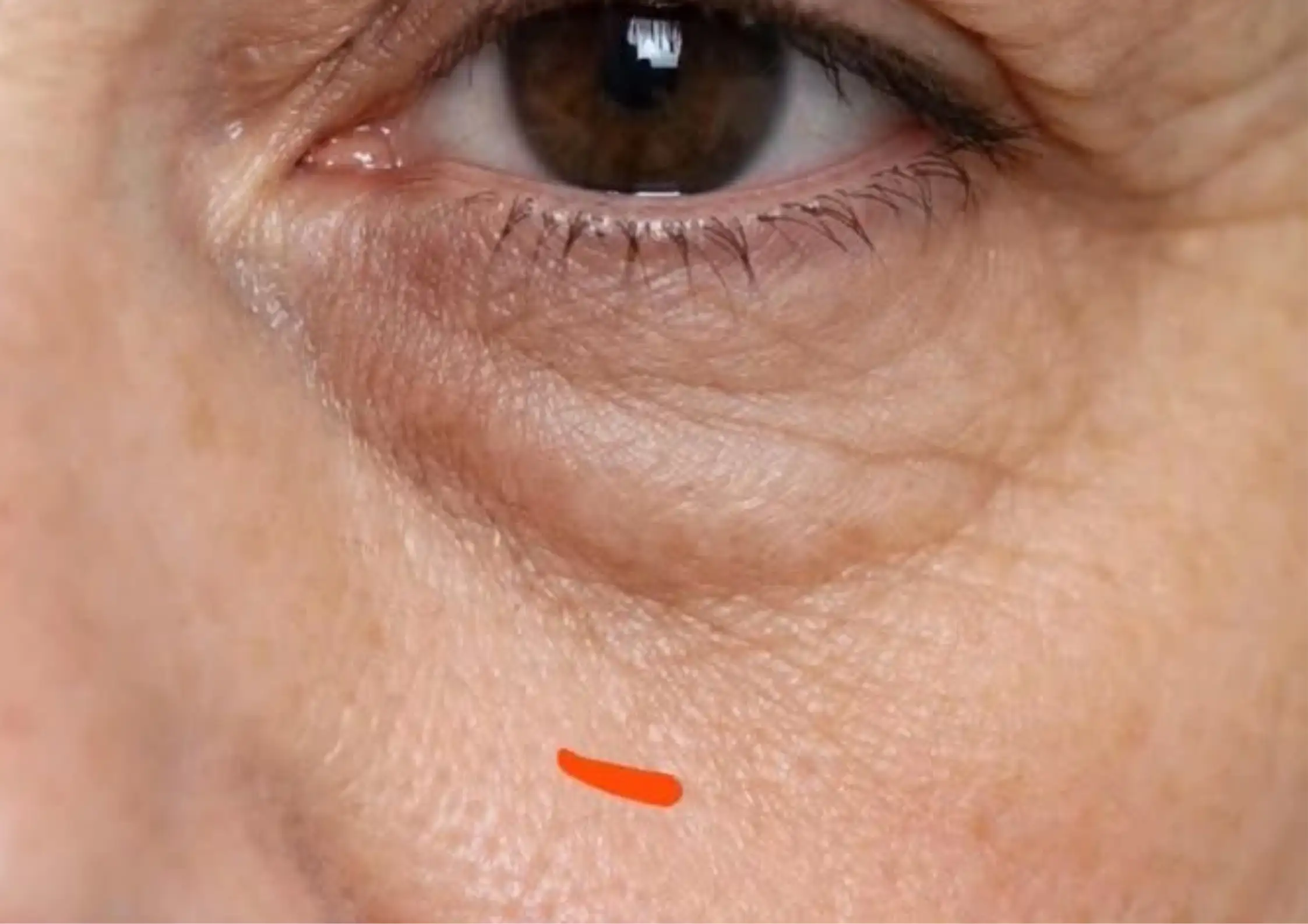 Under-Eye Ageing in Menopause: Why Hollowness and Creasing Accelerate